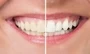 Teeth Bleaching Dental Service South Africa