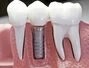 Dental Implants Saves Smile