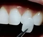 Dental Porcelain Veneers South Africa